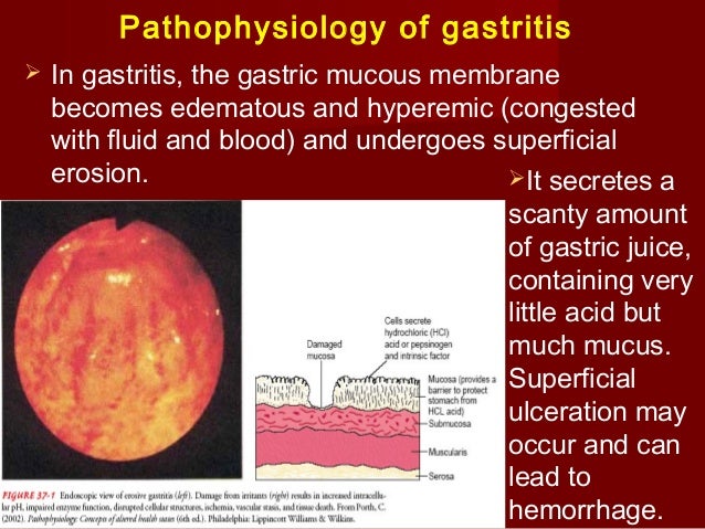 Erosion of the stomach: etiology and pathogenesis Erosion of the stomach: etiology and pathogenesis